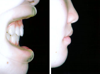 上顎前突＋叢生（乱杭歯）非抜歯症例4