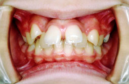 上顎前突＋叢生（乱杭歯）非抜歯症例1