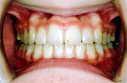 上顎前突＋叢生（乱杭歯）非抜歯症例2
